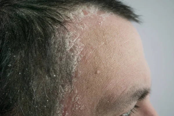 Psoriasis Línea Del Cabello Cuero Cabelludo Cerca Enfermedades Dermatológicas Problemas — Foto de Stock