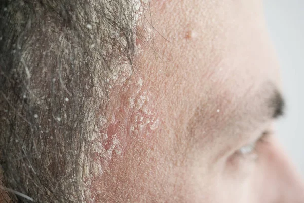 Psoríase Linha Cabelo Couro Cabeludo Perto Doenças Dermatológicas Problemas Pele — Fotografia de Stock