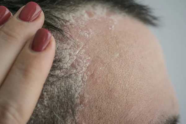 Psoríase Linha Cabelo Couro Cabeludo Perto Doenças Dermatológicas Problemas Pele — Fotografia de Stock