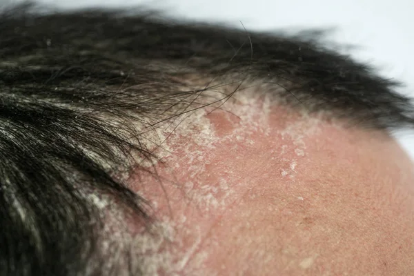 Psoriasis Línea Del Cabello Cuero Cabelludo Cerca Enfermedades Dermatológicas Problemas —  Fotos de Stock