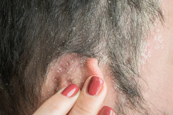 Łuszczyca Linii Włosów Skóry Głowy Zamknij Się Chorób Dermatologicznych Problemy — Zdjęcie stockowe