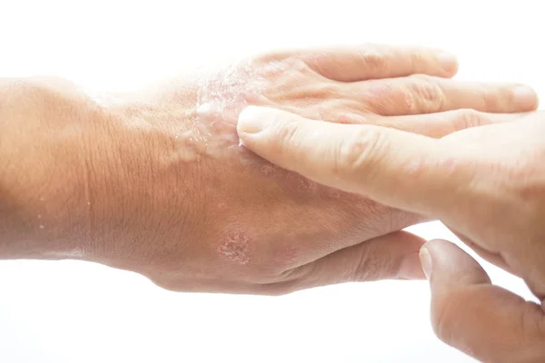 O uso de emoliente para pele seca escamosa, como no tratamento da psoríase, eczema e outras doenças da pele seca. isolado em fundo branco . — Fotografia de Stock