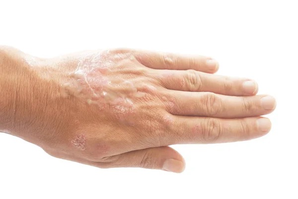 Psoriasis vulgar y hongo en la mano del hombre con placa, erupción cutánea y manchas en la piel, aislado sobre fondo blanco. Enfermedad genética autoinmune . — Foto de Stock