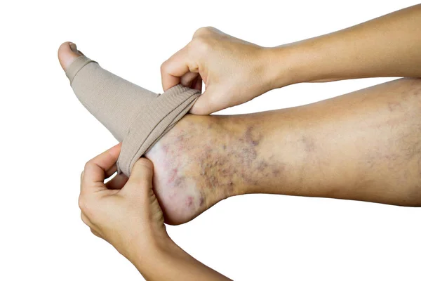 Μια γυναίκα βάζει μια κάλτσα συμπίεσης στο πόδι της με κιρσούς. Πρόληψη φλεβών, καλσόν συμπίεσης, ανακούφιση για κουρασμένα πόδια. γυναικεία πόδια σε κάλτσες. — Φωτογραφία Αρχείου