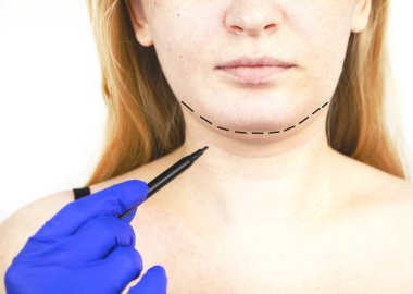 Mentoplasty: plastic chin. Patient before chin and neck surgery. Plastic surgeon advises clipart