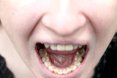 Hastanın, taş plak. Diş Hekimliği tedavi dental plak, profesyonel ağız hijyeni, Sigara ve cleaningteeth zarar kavramı