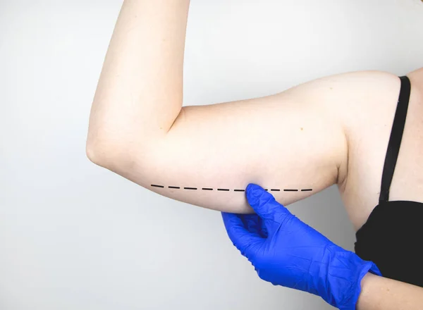 整形外科医は 手の皮膚を強化する準備中です Brachioplasty プラスチック製の腕 彼の手に掛かっている吊り皮膚 — ストック写真