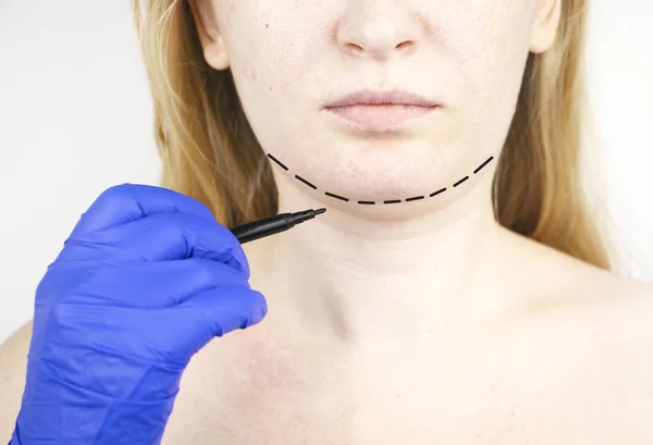 Mentoplasty Plastic Chin Patient Chin Neck Surgery Plastic Surgeon Advises — Stock Photo, Image