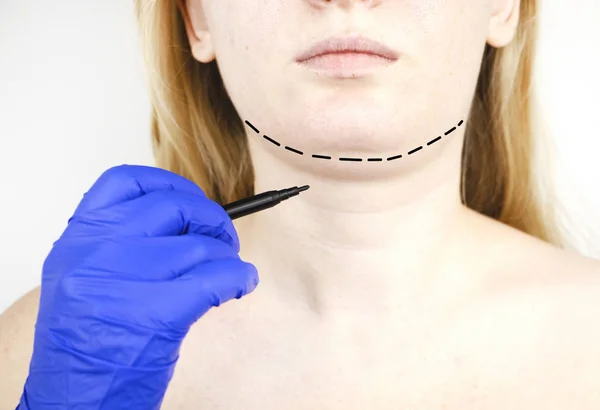 Mentoplasty Plastic Chin Patient Chin Neck Surgery Plastic Surgeon Advises — Stock Photo, Image