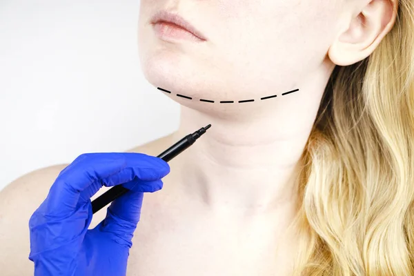 椎体成形术 塑料下巴 下巴和颈部手术前的病人 整形外科医生建议 — 图库照片