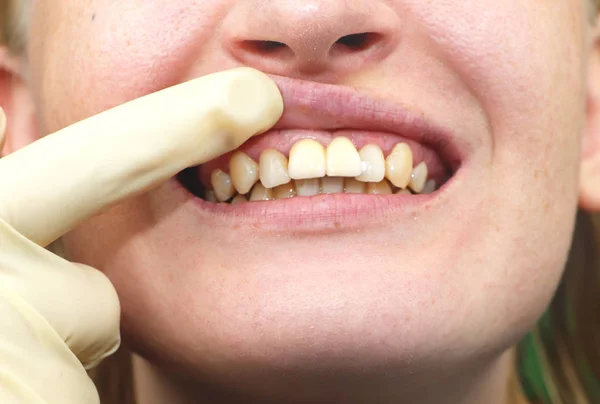 Крупним Планом Невдало Імплантовані Зубні Імплантати — стокове фото