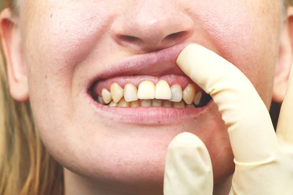 Close Implantes Dentários Implantados Sem Sucesso — Fotografia de Stock