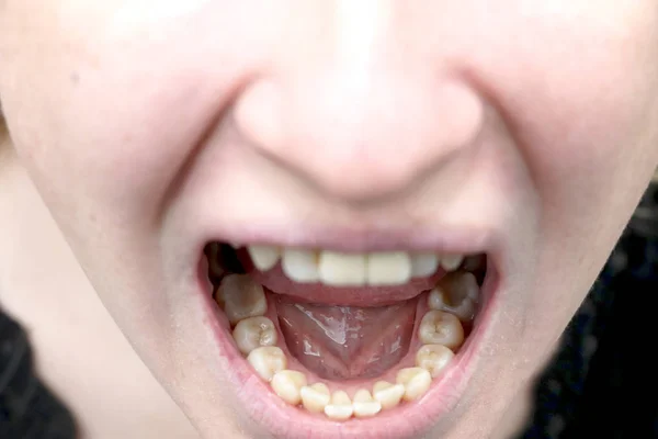 Наліт Пацієнта Камінь Стоматологічне Лікування Зубного Нальоту Професійна Гігієна Порожнини — стокове фото
