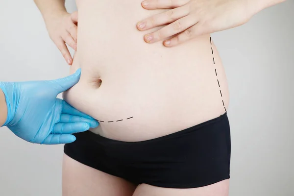 Karın Germe Torsoplasty Karın Liposuction Önlük Kaldırılması Plastik Cerrah Resepsiyonda — Stok fotoğraf
