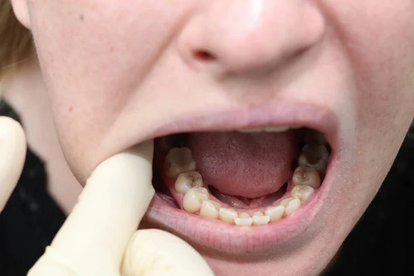 Placa Del Paciente Piedra Tratamiento Odontológico Placa Dental Higiene Bucal —  Fotos de Stock