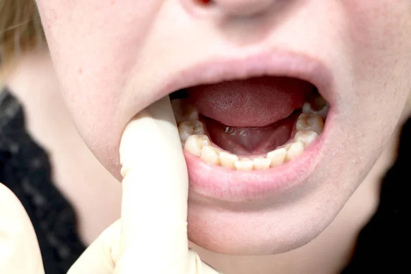 Placa Del Paciente Piedra Tratamiento Odontológico Placa Dental Higiene Bucal — Foto de Stock