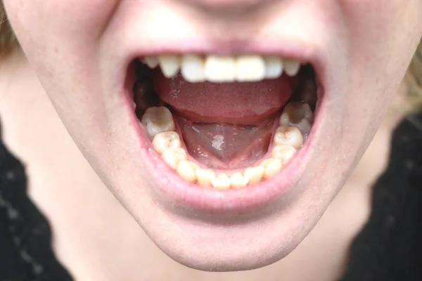 Placa Paciente Pedra Tratamento Odontológico Placa Dentária Higiene Oral Profissional — Fotografia de Stock