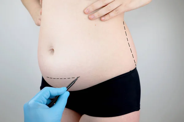 Abdominoplastia Torsoplastia Lipoaspiração Abdominal Retirada Avental Paciente Recepção Cirurgião Plástico — Fotografia de Stock