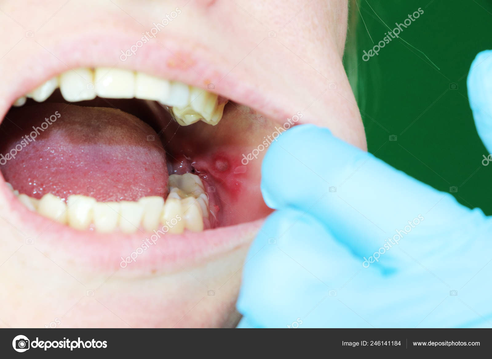 canker sore on cheek near wisdom tooth