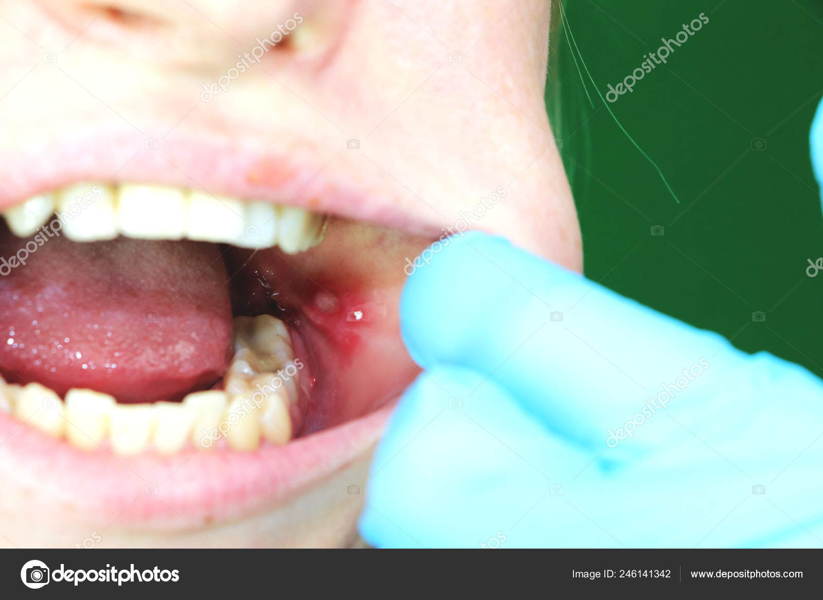 Painful Ulcer Stomatitis Mucous Cheek Girl Operation Remove Wisdom