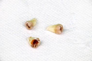 Kaldırılan yirmilik diş beyaz