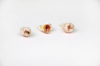 Kaldırılan yirmilik diş beyaz