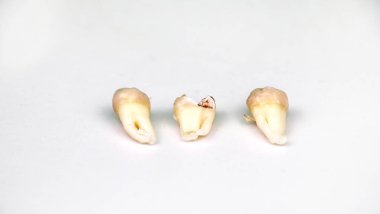 Kaldırılan yirmilik diş beyaz