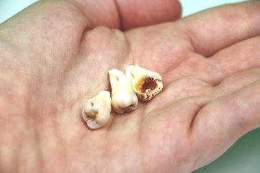 Kaldırılan yirmilik diş beyaz