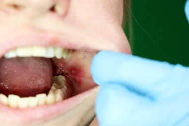 Ağrılı ülser ve Stomatit bir kızın müköz yanağına. Yirmi yaş dişleri kaldırma işleminden sonra. Dikiş ve postoperatif dönemde