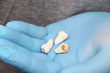 Bir yirmilik diş çıkardıktan sonra bir adam. Sekizinci dişleri çıkarmak işlemi