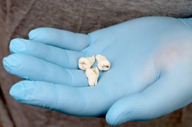 Bir yirmilik diş çıkardıktan sonra bir adam. Sekizinci dişleri çıkarmak işlemi