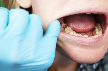Derin çürük, açık kanallar, Kanal temizleme. Stomatolon giriş, periodontitis tedavi üzerinde hastaya