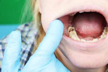 Derin çürük, açık kanallar, Kanal temizleme. Stomatolon giriş, periodontitis tedavi üzerinde hastaya