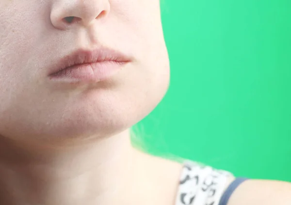 Teeth Problem Gumboil Flux Swelling Cheek Closeup Beautiful Sad Girl — Stock Photo, Image