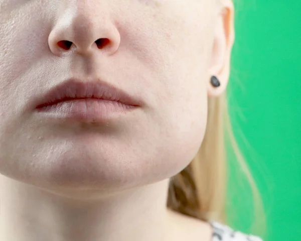 Teeth Problem Gumboil Flux Swelling Cheek Closeup Beautiful Sad Girl — Stock Photo, Image