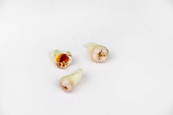 Dente Sabedoria Removido Branco — Fotografia de Stock