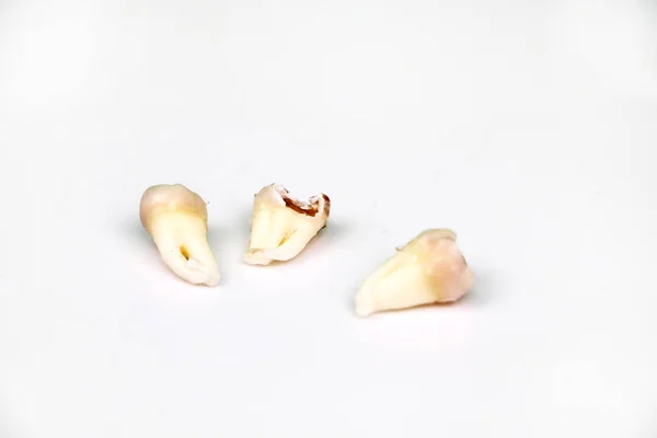 Dente Sabedoria Removido Branco — Fotografia de Stock