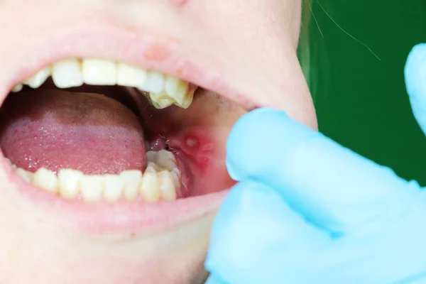 Bolesne Owrzodzenie Zapalenie Jamy Ustnej Śluzowej Policzka Dziewczyny Operacji Usunięcia — Zdjęcie stockowe