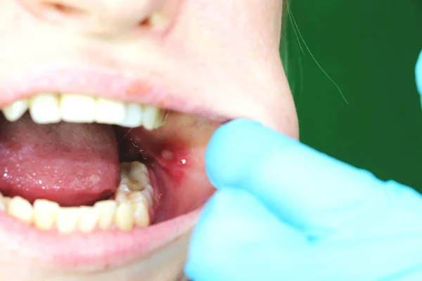 Úlcera Dolorosa Estomatite Bochecha Mucosa Uma Menina Após Operação Para — Fotografia de Stock