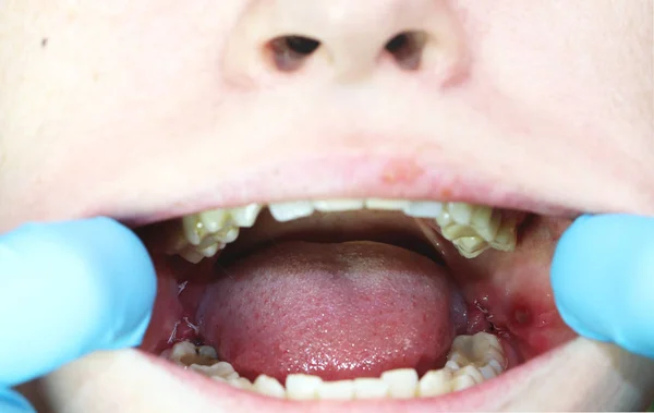 Операція Видалення Зубів Мудрості Вісім Шиття Післяопераційний Період — стокове фото