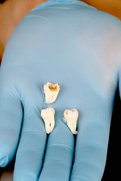 A man after removing a wisdom tooth. The operation to remove the eighth teeth