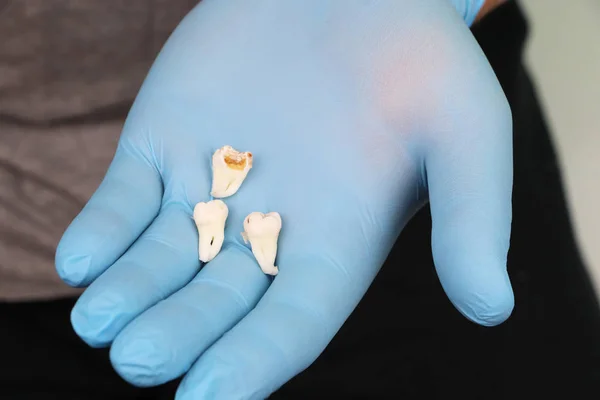 A man after removing a wisdom tooth. The operation to remove the eighth teeth