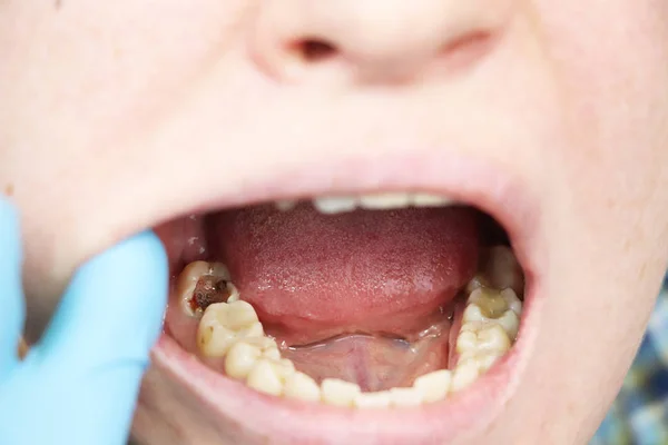 Caries Profunda Canales Abiertos Canales Limpieza Paciente Estomatología Ingreso Tratamiento — Foto de Stock