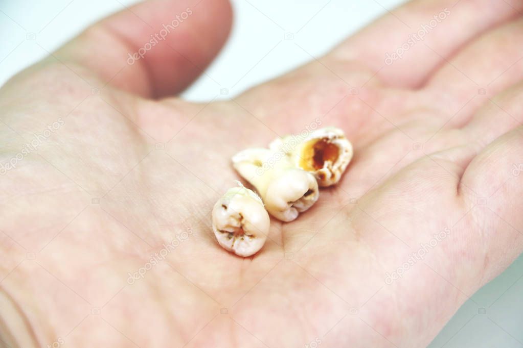 Removed wisdom tooth on white