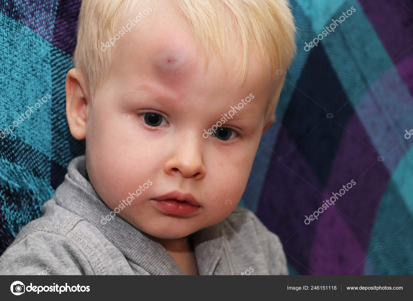 Big Bruise Forehead Little Boy Stock Photo by ©Alena1919 246151118