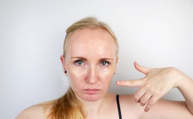 Yağlı ve sorunlu cilt. Sivilceli, yağlı ciltli ve pigmentasyonlu sarışın bir kızın portresi.