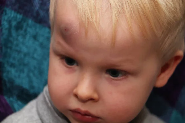 Big Bruise Forehead Little Boy — Stock Photo, Image