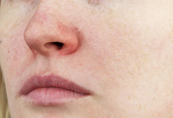 Cuperosi Naso Una Giovane Donna Acne Sul Viso Esame Parte — Foto Stock