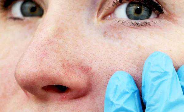 Cuperose Auf Der Nase Einer Jungen Frau Akne Gesicht Untersuchung — Stockfoto