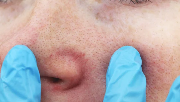 一个年轻女子鼻子上的割草病 痤疮在脸上 由医生进行检查 — 图库照片